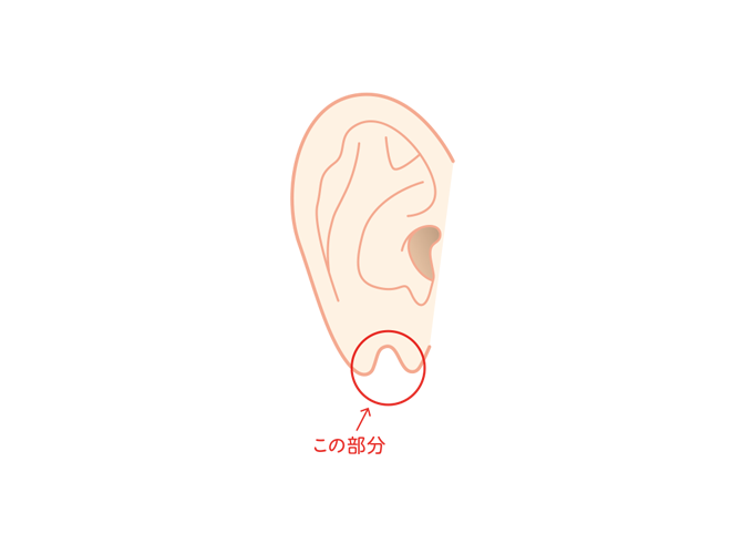 耳垂裂01