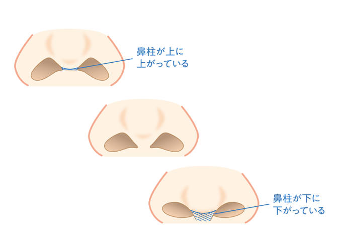 鼻柱形成術01