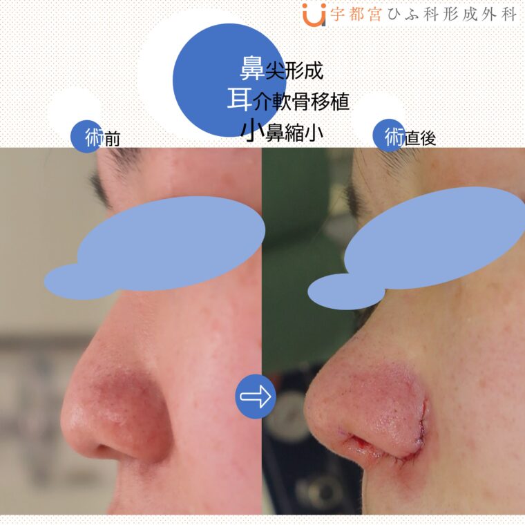 美容外科の症例紹介　鼻