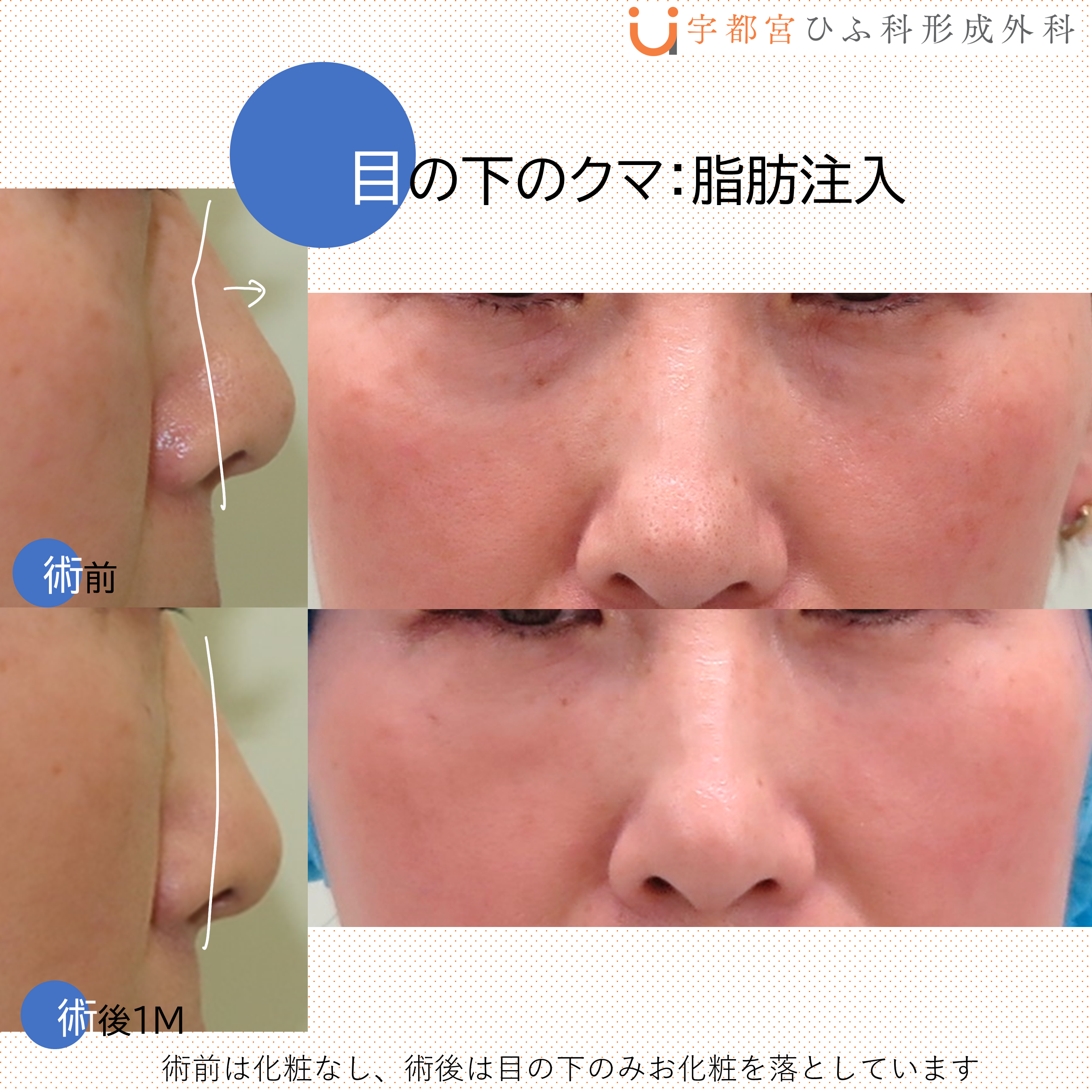 目の下のたるみにWennil 目の下のたるみにWennil 楽天市場】【期間限定ポイント2倍】EMS