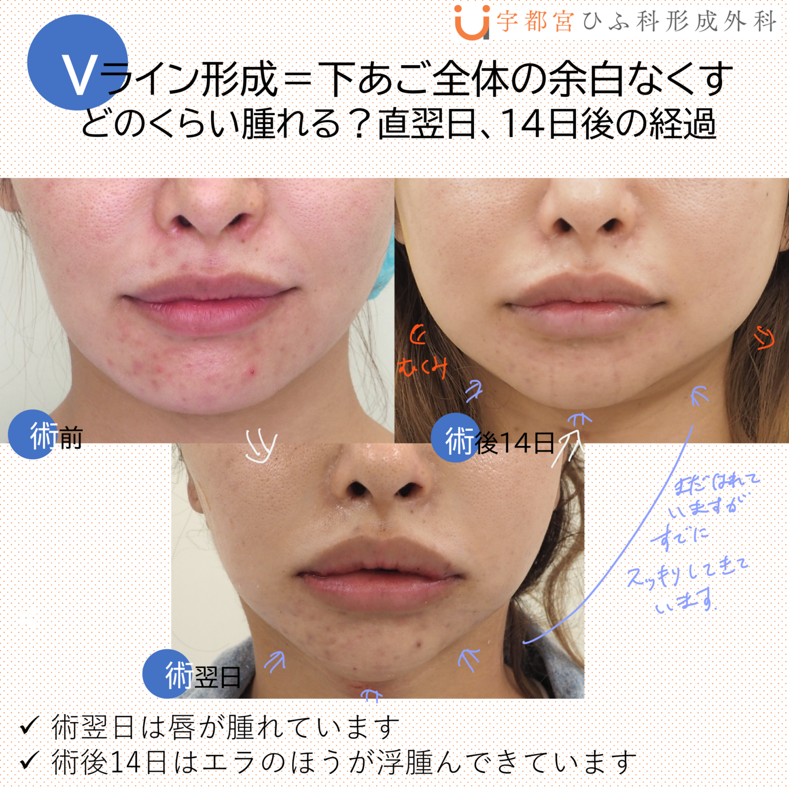 美容外科症例：Vライン骨切り（下あごを総合的に小さくする）の経過紹介 | 徳島市住吉｜宇都宮ひふ科形成外科｜眼瞼下垂・わきが・美容外科