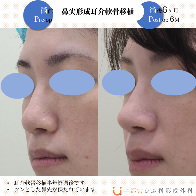 美容外科症例：鼻尖形成、軟骨移植